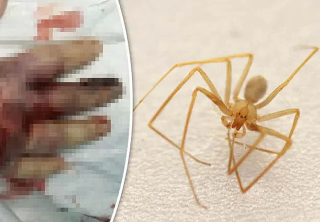 Spider Bite के बाद 76 दिन तक जूझना पडा बच्ची को, हाथ में वायरस की तरह फैली खतरनाक बीमारी