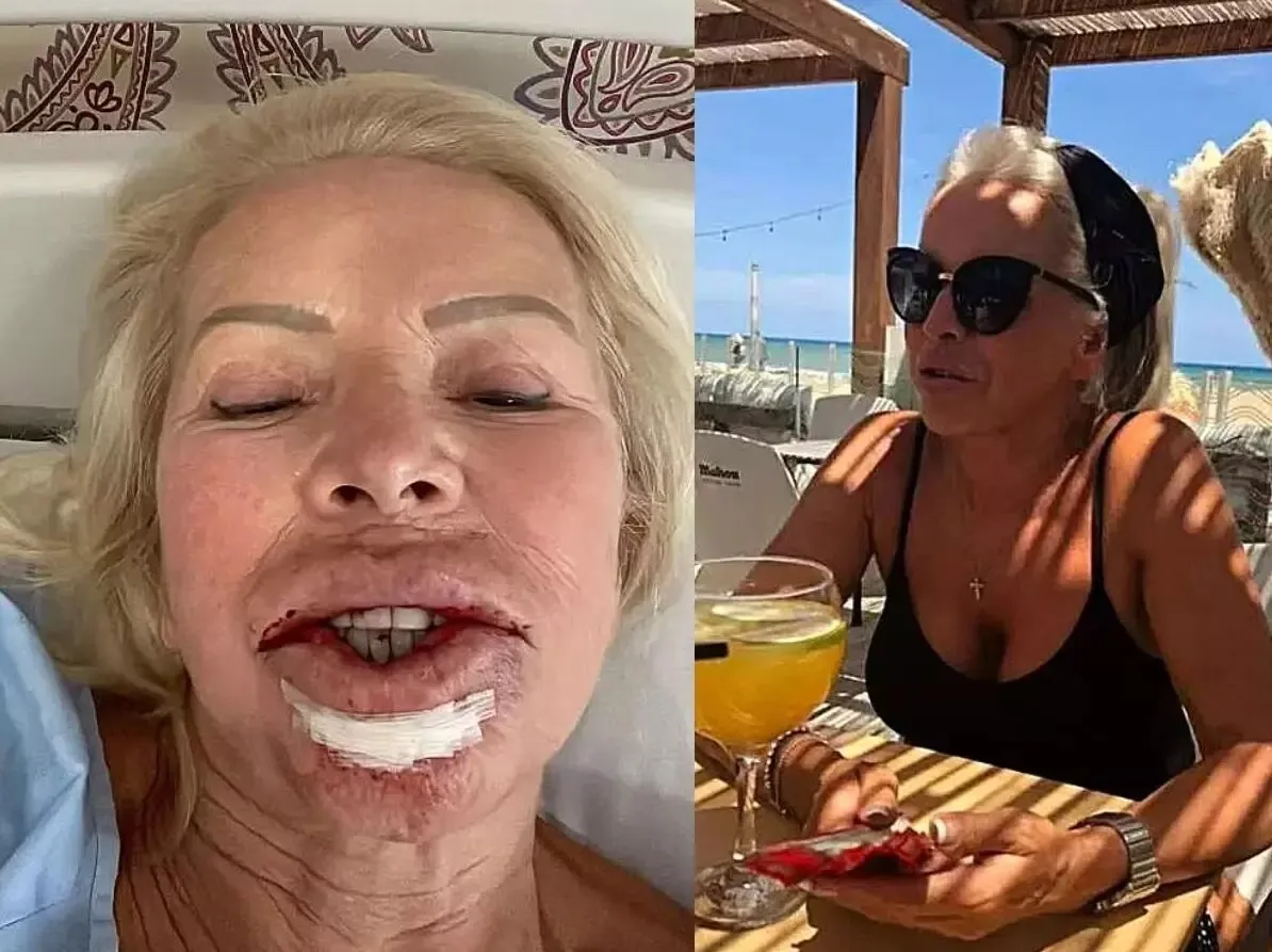 Beautiful दिखने कराई होठों की सर्जरी, हो गया कैंसर