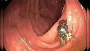 शख्स की आंत में मिली ज़िंदा मक्खी, ‎Doctors ने जताई हैरानी