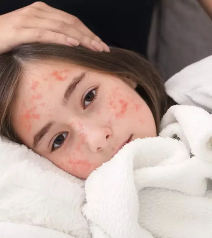 खसरा सबसे संक्रामक रोगों में से एक -खसरे का virus ऊपरी श्वसन नली को करता है संक्रमित