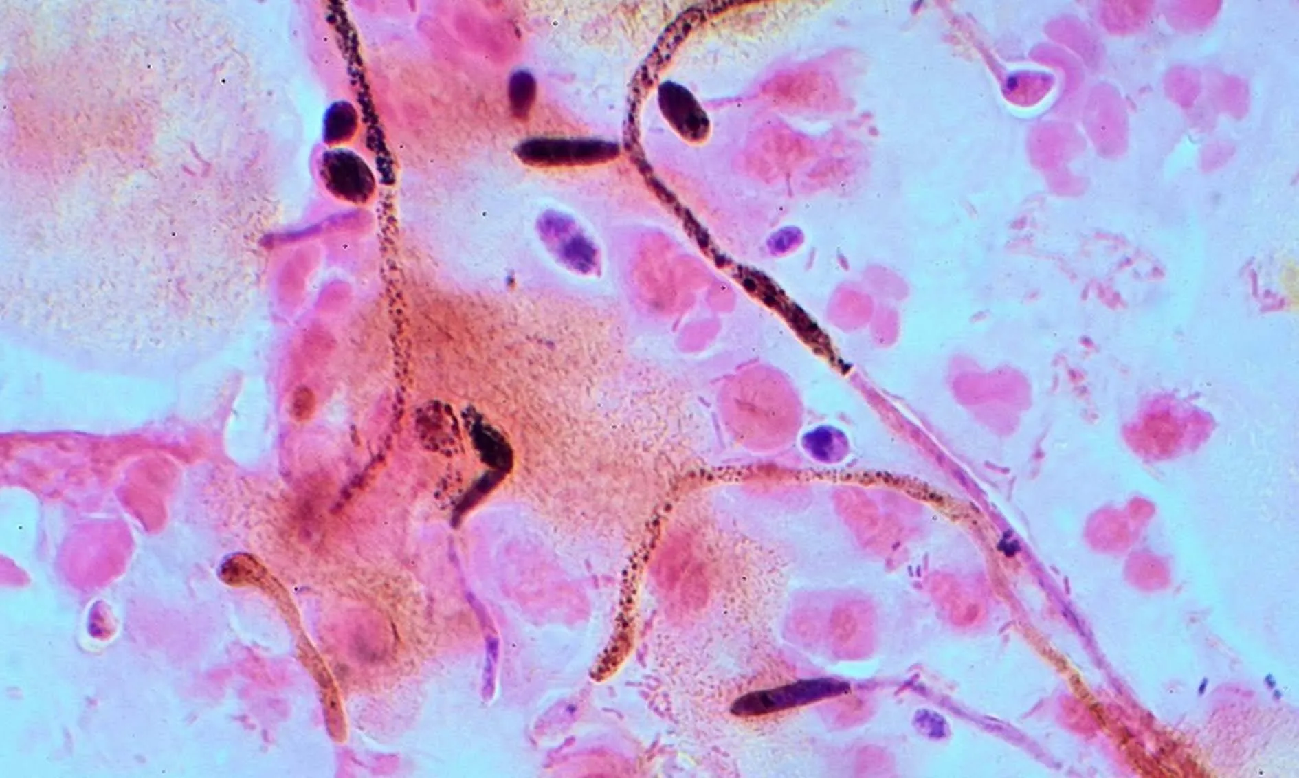 Candida auris नामक संक्रमण बेहद घातक