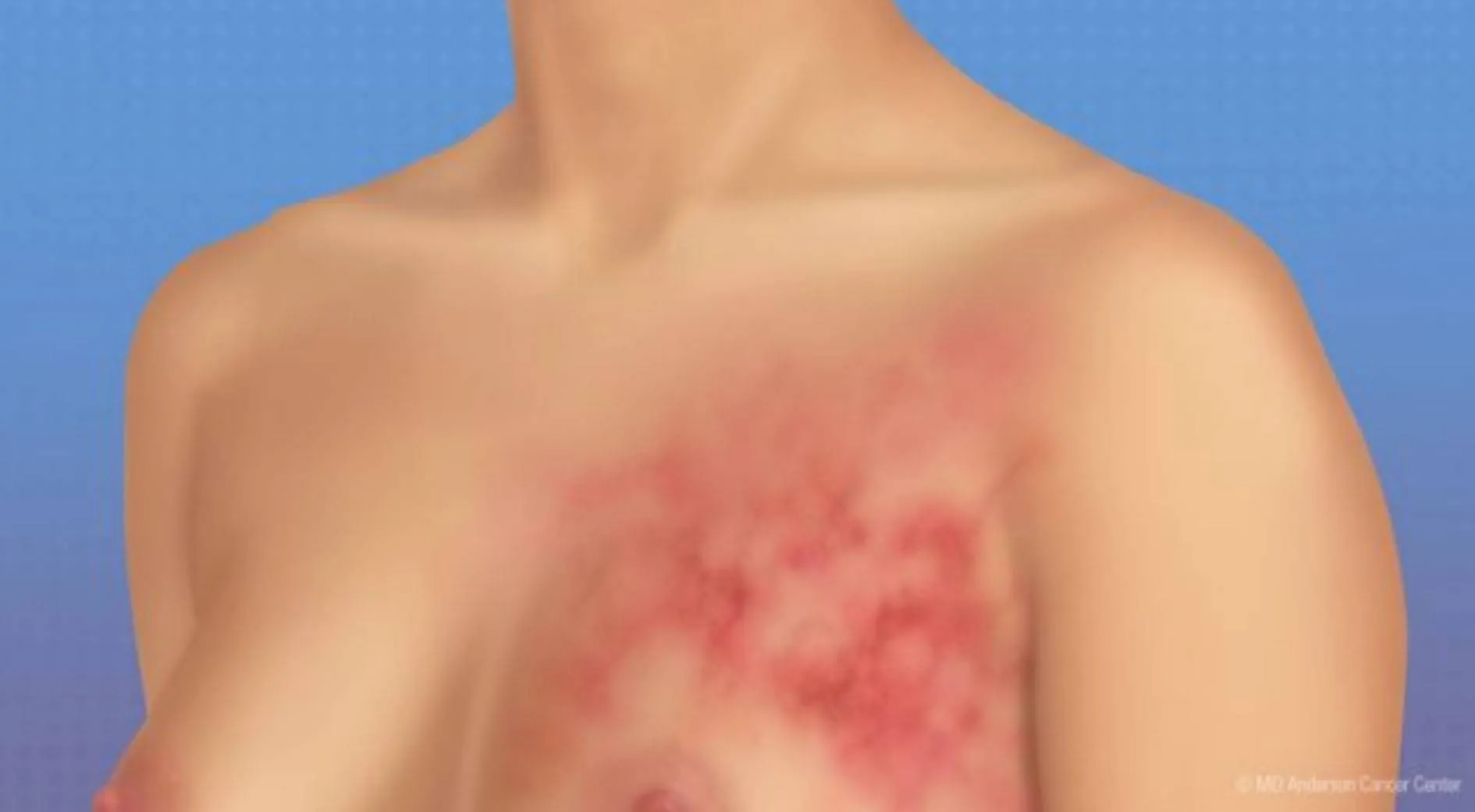 ऐसी महिलाओं को रहता है Breast Cancer का 80 प्रतिशत जोखिम