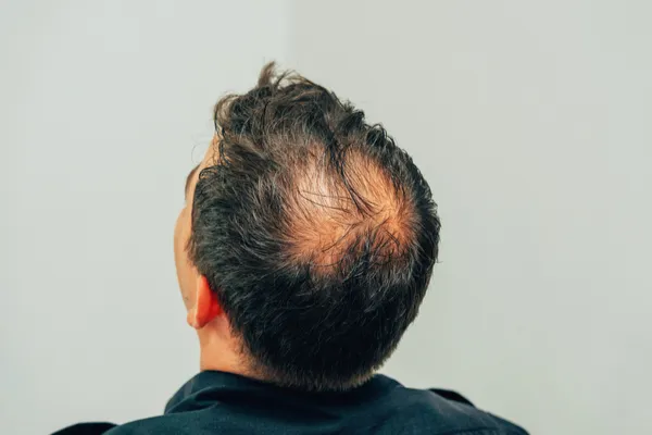 गंजेपन से पाना चाहते हैं छुटकारा तो आजमाएं ये Tips